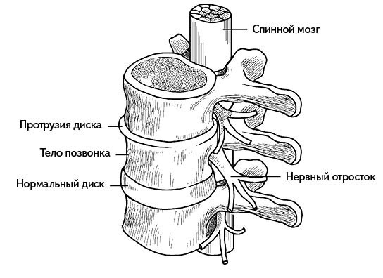 Жизнь без боли в спине. Лечение сколиоза, остеопороза, остеохондроза, межпозвонковой грыжи без операции Жизнь без боли в спине. Лечение сколиоза, остеопороза, остеохондроза, межпозвонковой грыжи без операции