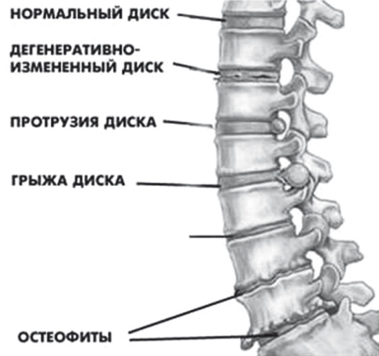 Лучшие методы лечения остеохондроза Лучшие методы лечения остеохондроза